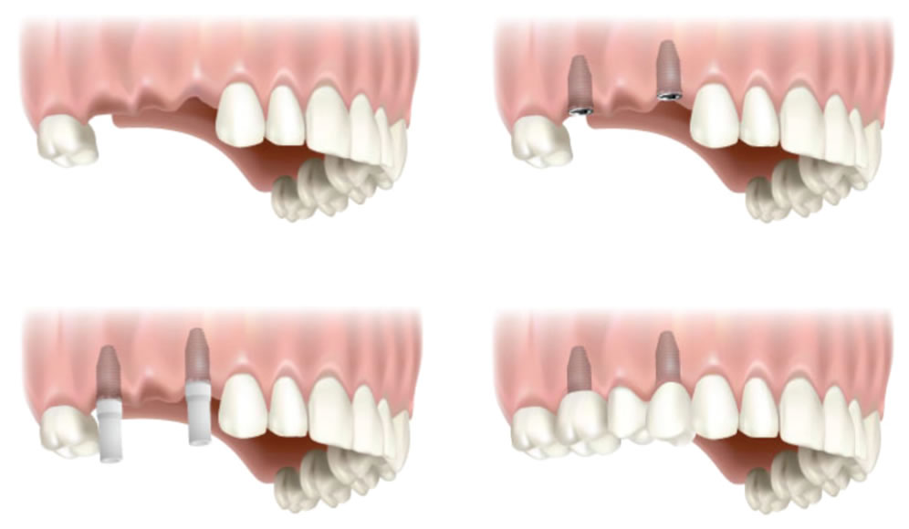 two-tooth-implant
