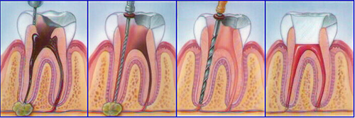 endo2